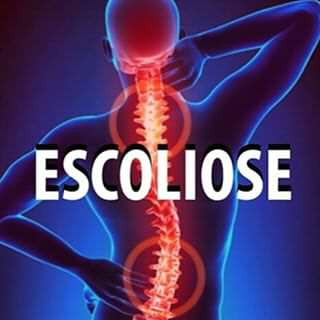Escoliose 1