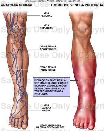 Trombose Venosa 3