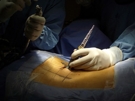 Cirurgia pouco invasiva da coluna 2