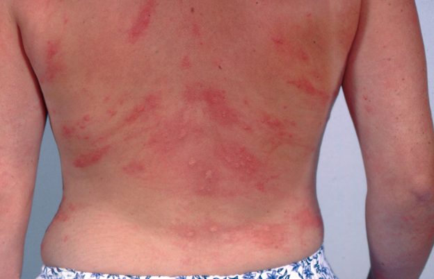 Urticária Crônica Espontânea 2