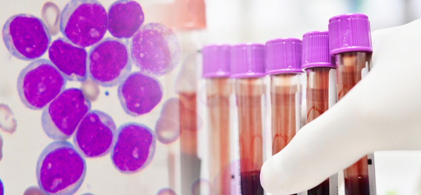 Leucemia Linfóide Crônica 4