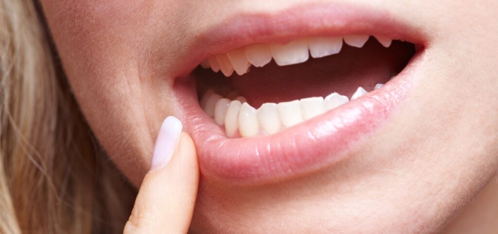 Coordenadora da Saúde Bucal de Campinas, Rosana da Costa Selhi fala sobre a campanha contra o câncer de boca e outros assuntos